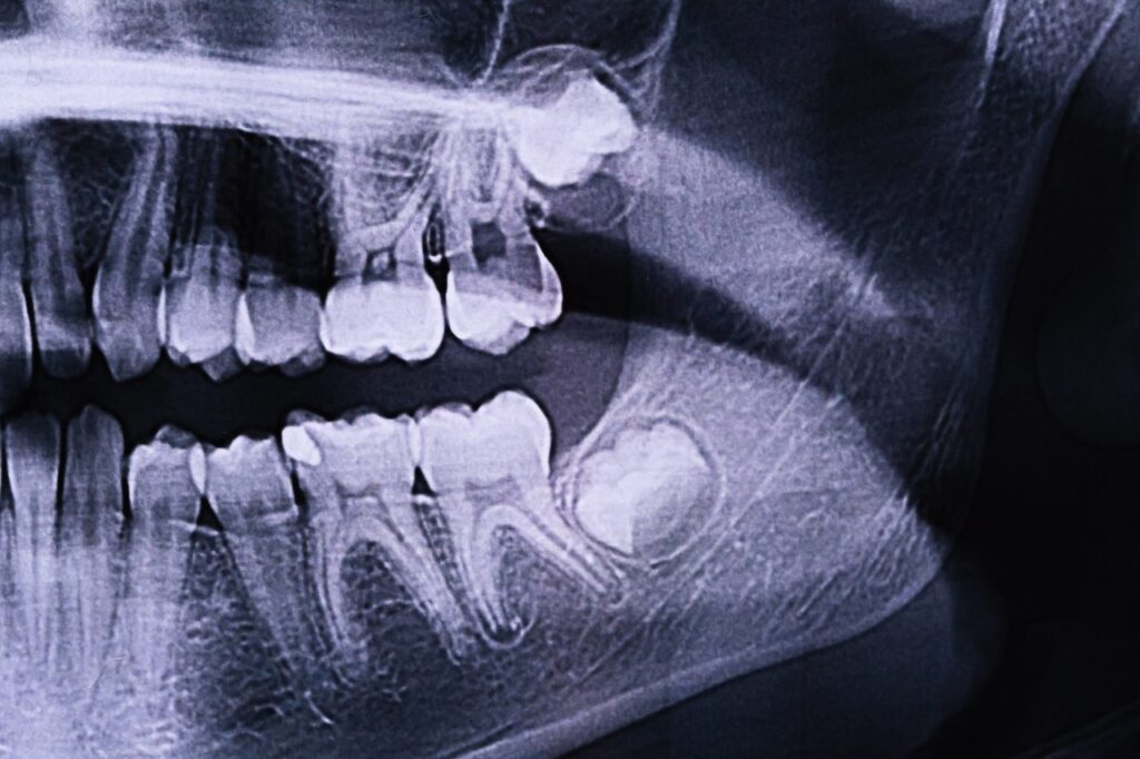 A panoramic X-ray of the jaw with wisdom teeth in the gums